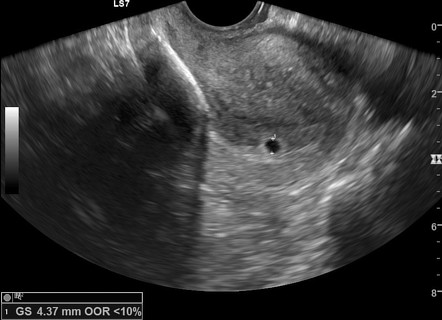 Pregnancy with intrauterine contraceptive device | Radiology Case ...