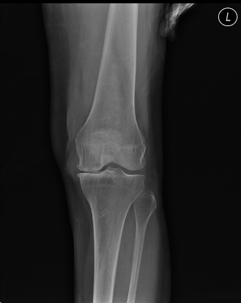 Meniscal Extrusion Ultrasound Image Radiopaedia Org