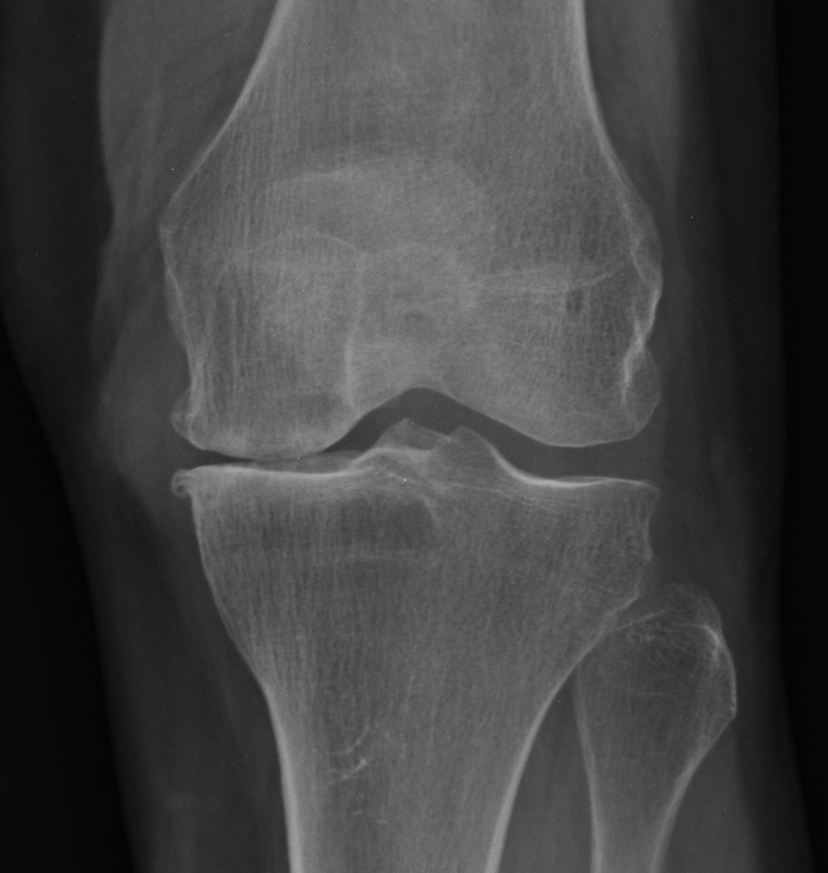 Meniscal Extrusion Ultrasound Image