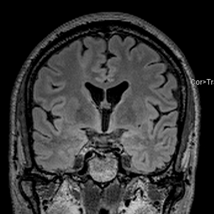 Taylor dysplasia | Radiology Reference Article | Radiopaedia.org