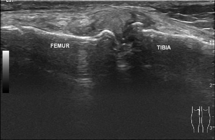 Meniscal Extrusion Ultrasound Image Radiopaedia Org