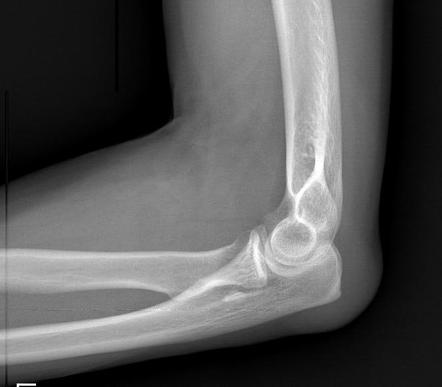 Olecranon bursitis | Image | Radiopaedia.org