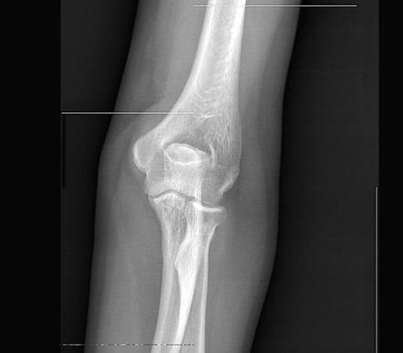 Olecranon bursitis | Image | Radiopaedia.org