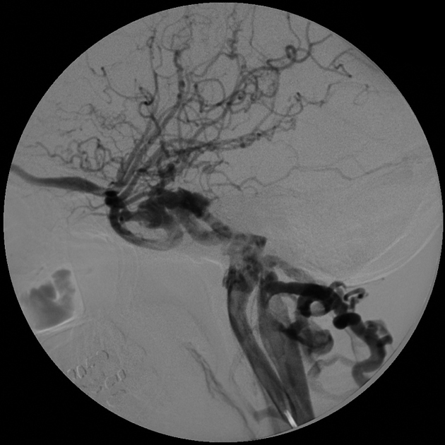 Barrow classification of caroticocavernous fistulae Radiology