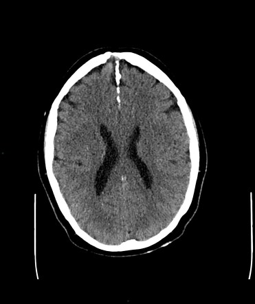 Gorlin-Goltz syndrome | Image | Radiopaedia.org