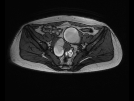 Endometrioma Mri