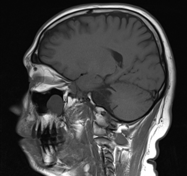 Arachnoid Cyst Cerebellopontine Angle Image 0967