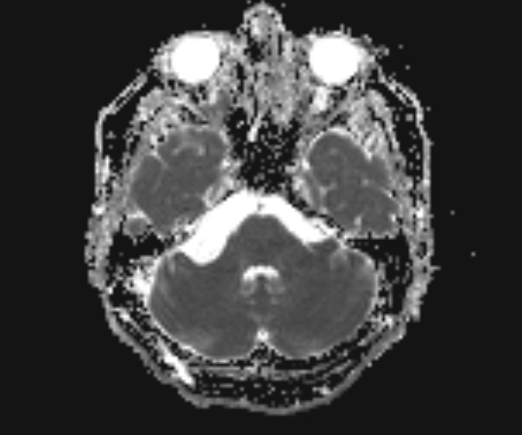 Arachnoid Cyst Cerebellopontine Angle Image 0814