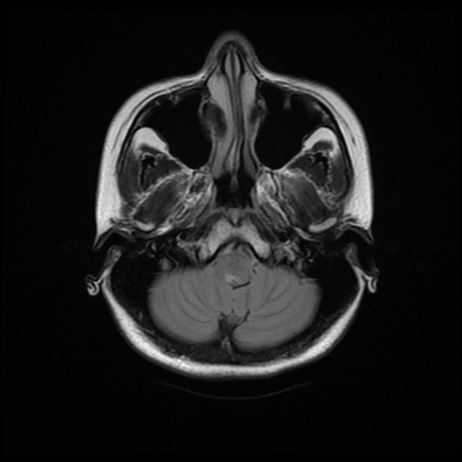 Area postrema syndrome | Image | Radiopaedia.org