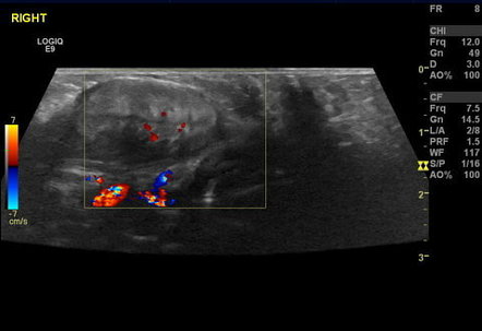 Fibromatosis colli | Radiology Case | Radiopaedia.org