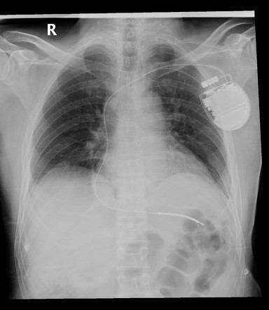 Implantable cardioverter-defibrillator with cardiac perforation ...