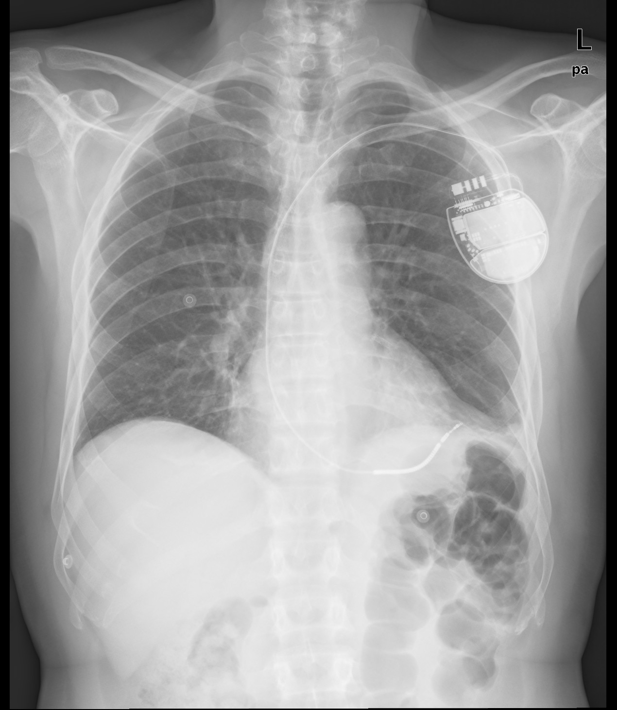 Implantable Cardioverter Defibrillator With Cardiac Perforation Image 