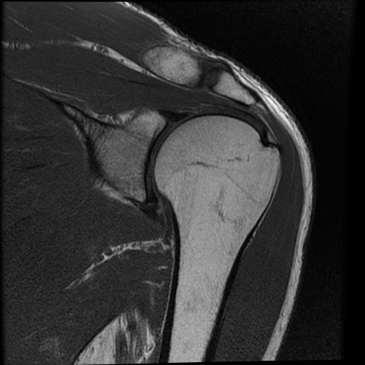 Biceps pulley injury | Image | Radiopaedia.org