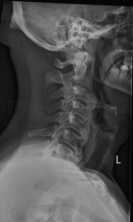 Diffuse idiopathic skeletal hyperostosis - cervical spine | Radiology ...