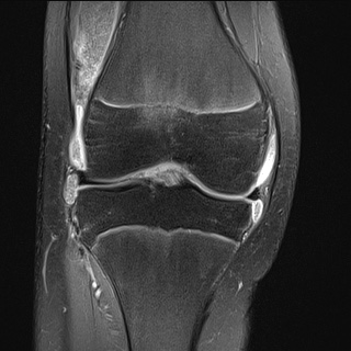 Rice bodies - juvenile idiopathic arthritis | Image | Radiopaedia.org