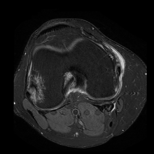 Medial collateral ligament rupture | Image | Radiopaedia.org