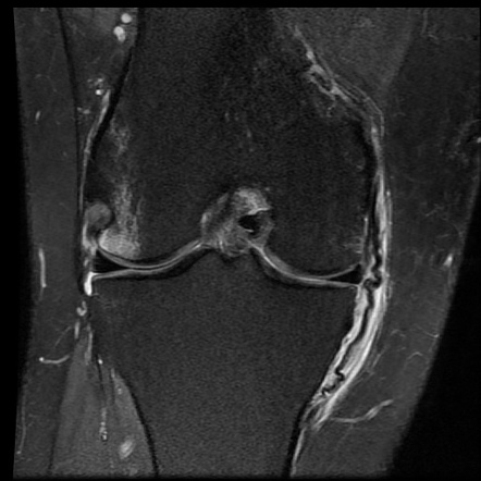 Medial collateral ligament rupture | Radiology Case | Radiopaedia.org