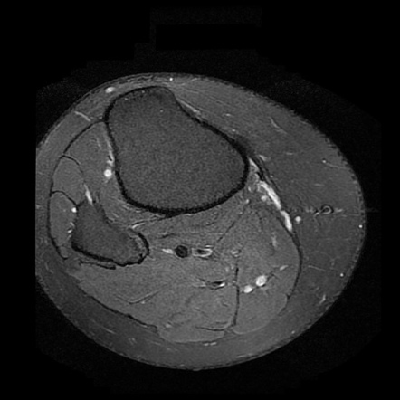 Medial Collateral Ligament Rupture | Image | Radiopaedia.org