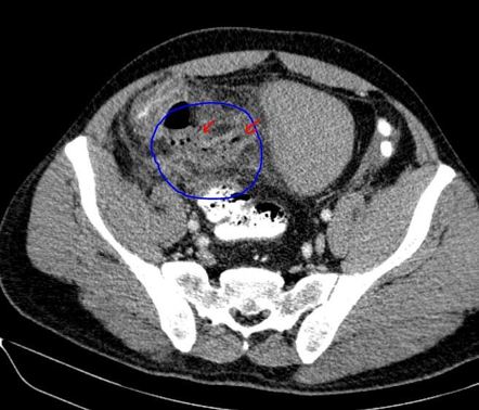 Appendicular phlegmon | Image | Radiopaedia.org