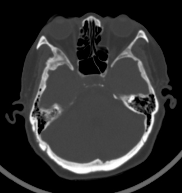 Lamina Papyracea Of The Ethmoid Bone