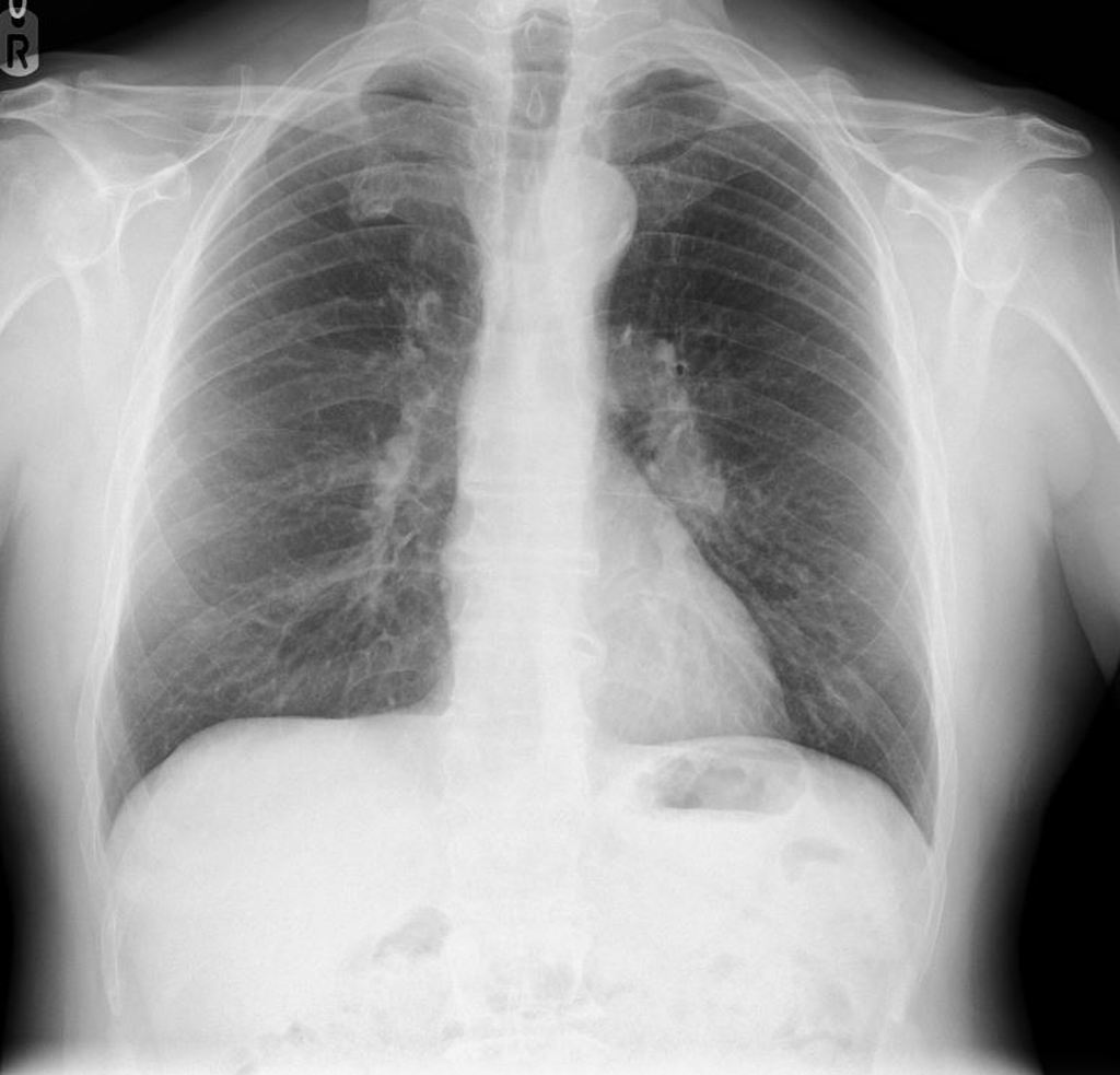 Hilar Lung Cancer Radiology Case Radiopaedia Org