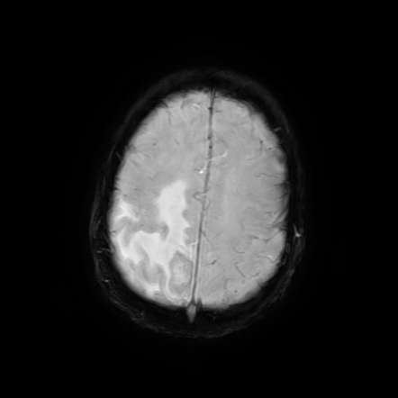 Cerebral tuberculoma | Image | Radiopaedia.org