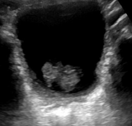 Rhabdomyosarcoma (genitourinary tract) | Radiology Reference Article