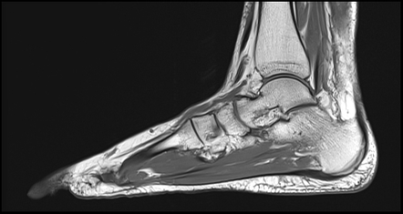 Plantar deals fasciitis radiopaedia