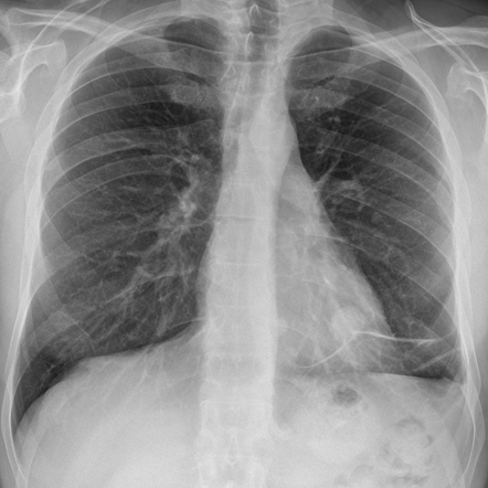 Retrocardiac lung nodules (chest radiograph) | Radiology Case ...