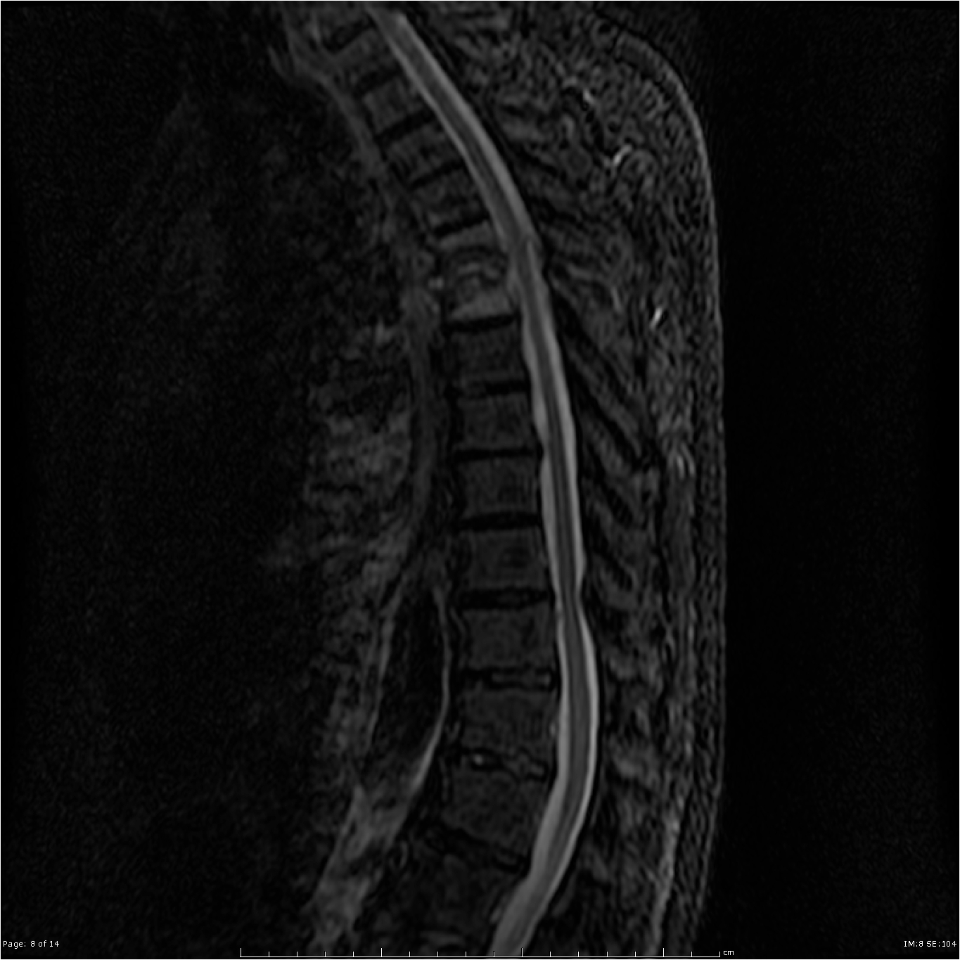 Discitis Involving The Thoracic Spine | Image | Radiopaedia.org