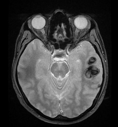 Cerebral venous thrombosis with cerebral venous infarction | Radiology ...