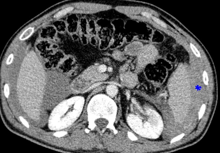 File:Spleen injury grade V (Radiopaedia 80897-94441 Axial portal phase ...