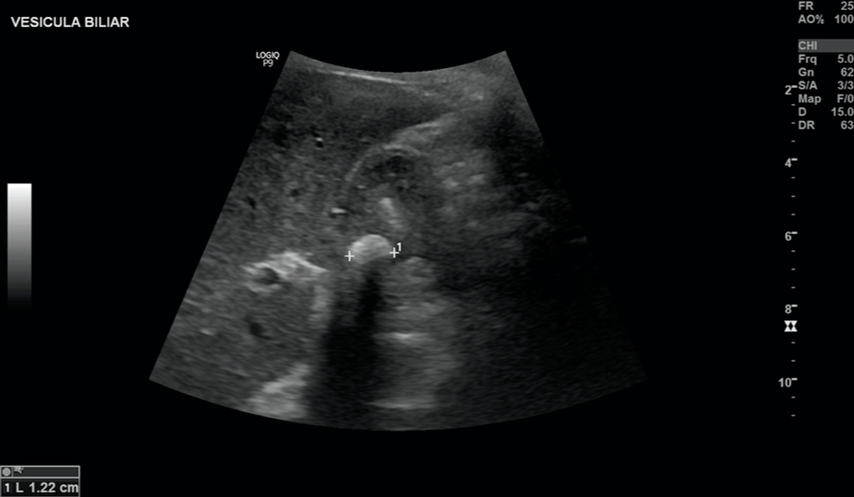 Chronic Cholecystitis Image