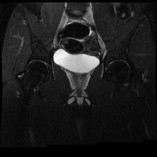 Undescended Testis Mri Image