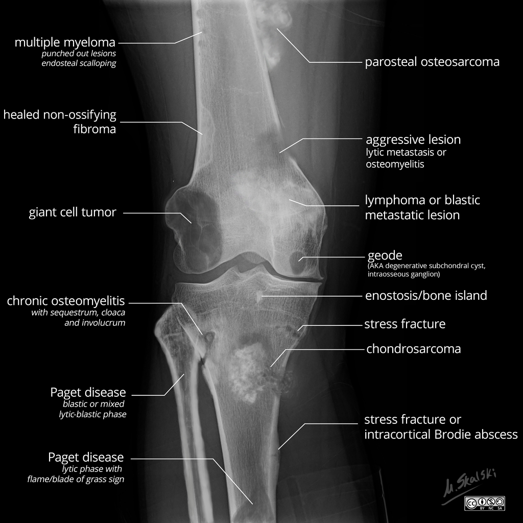 what-is-a-bone-lesion-technology-guideliness