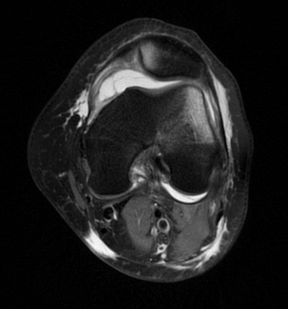 sequelae of transient lateral patellar dislocation icd 10