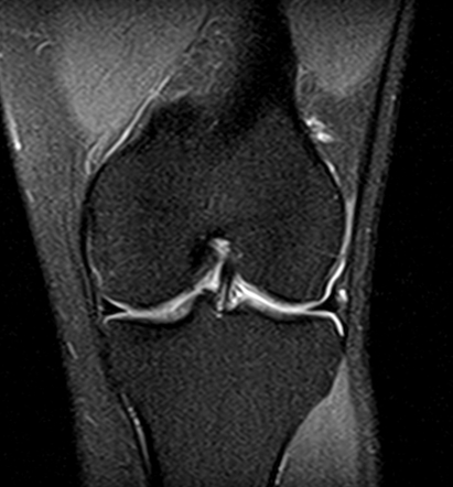 Jumper's knee | Image | Radiopaedia.org