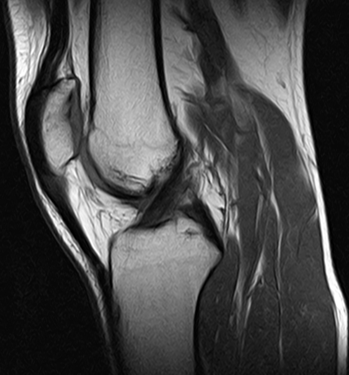 Jumper's knee | Image | Radiopaedia.org