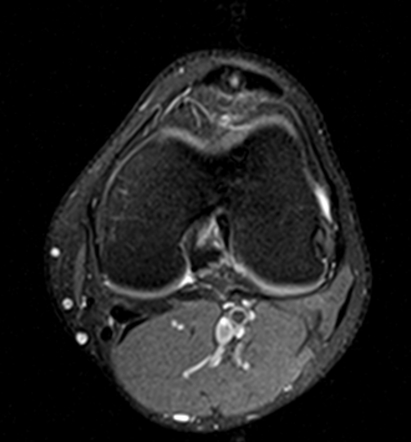 Jumper's knee | Image | Radiopaedia.org