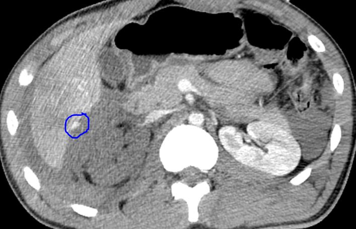 Liver And Kidney Trauma - Aast Grade V 