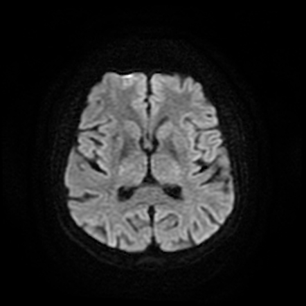 Cerebral metastases - melanoma | Image | Radiopaedia.org