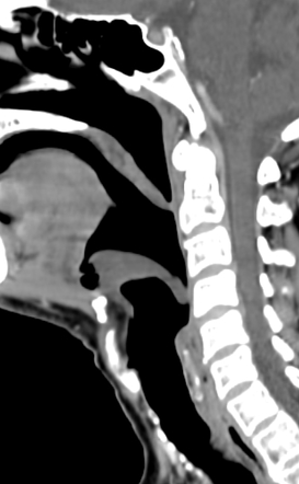 Epiglottic cyst | Radiology Case | Radiopaedia.org