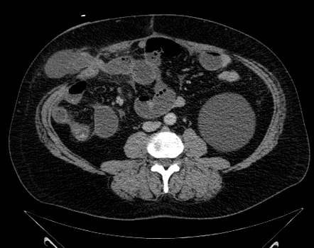 Parastomal Hernia 