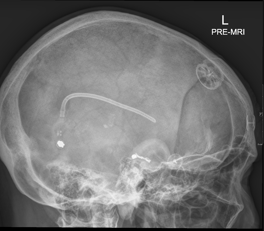 Programmable Medtronic Ventriculoperitoneal Shunt Image