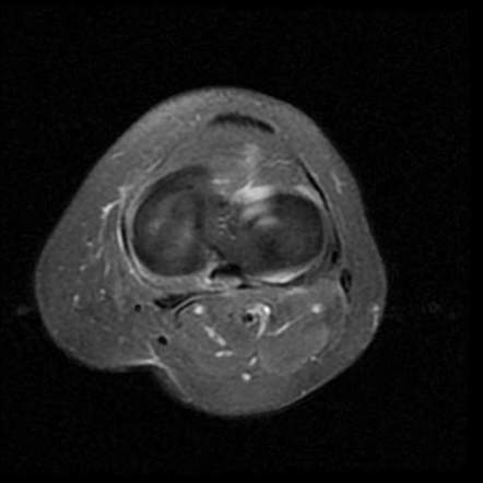 Popliteus Tendon Ganglia 