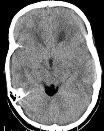 Intracranial lipoma - quadrigeminal cistern | Radiology Case ...