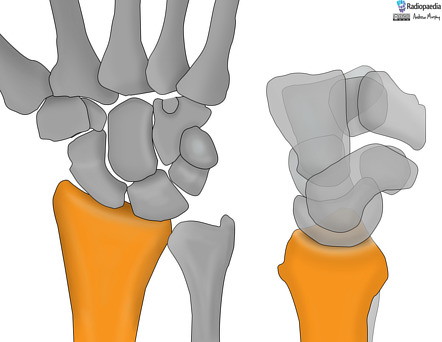 Carpal bones | Radiology Reference Article | Radiopaedia.org