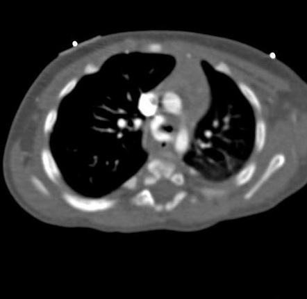 Pulmonary sling - aberrant left pulmonary artery | Radiology Case ...