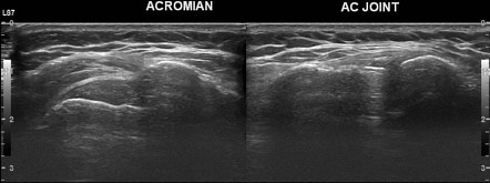 Iatrogenic injury of the spinal accessory nerve | Image | Radiopaedia.org