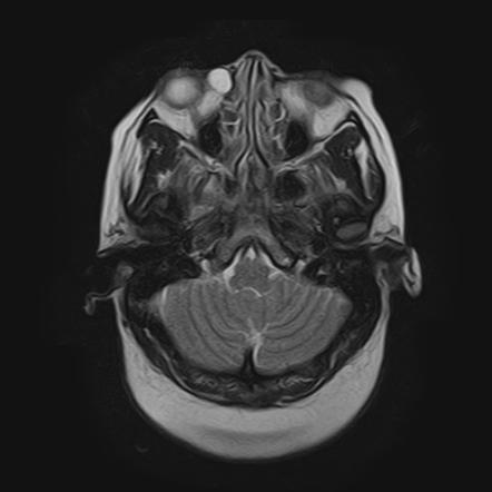 nasolacrimal cyst